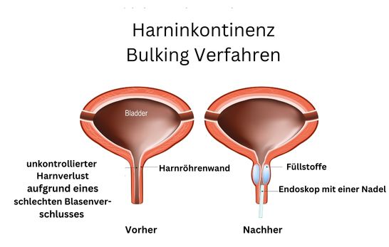 Aufpolsterung Harnröhre